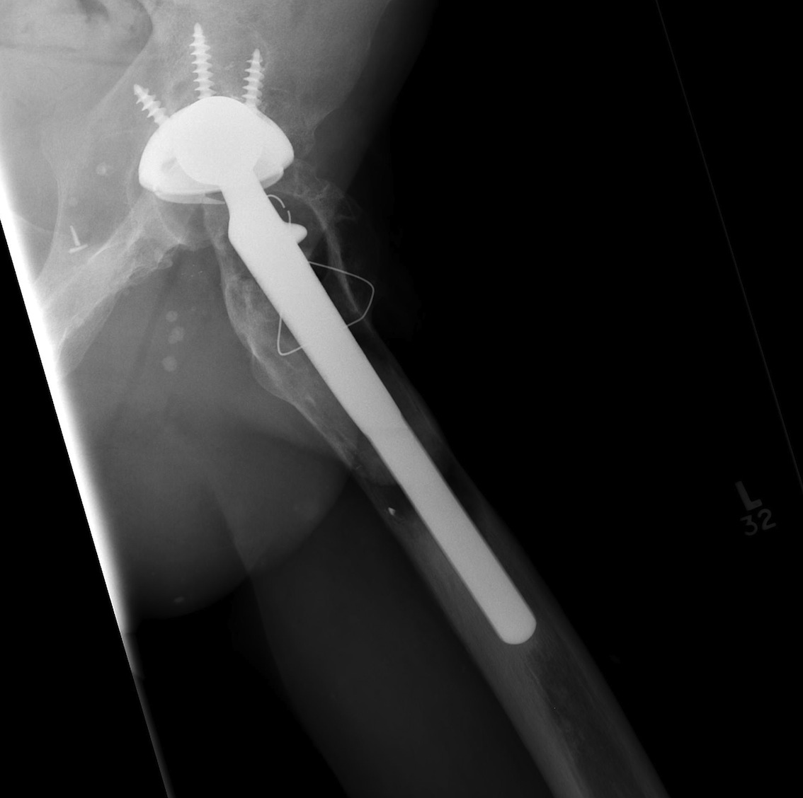 Type 3A Femur Lateral
